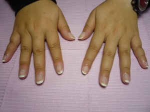 2012-11-11 深爪ケア終了ケア後①